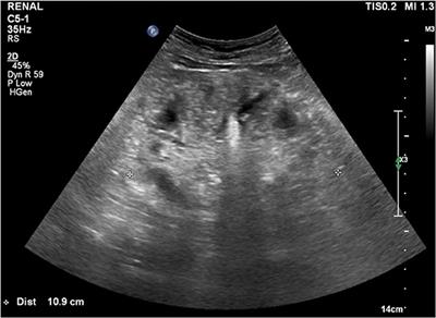 Case Report: Acute Kidney Injury Due to Chronic Milk-Alkali Syndrome in a Patient With Colon Cancer